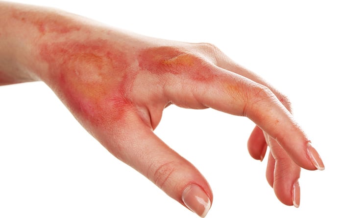 آیا ممکن است در اثر جوشکاری سرطان پوست گرفت؟