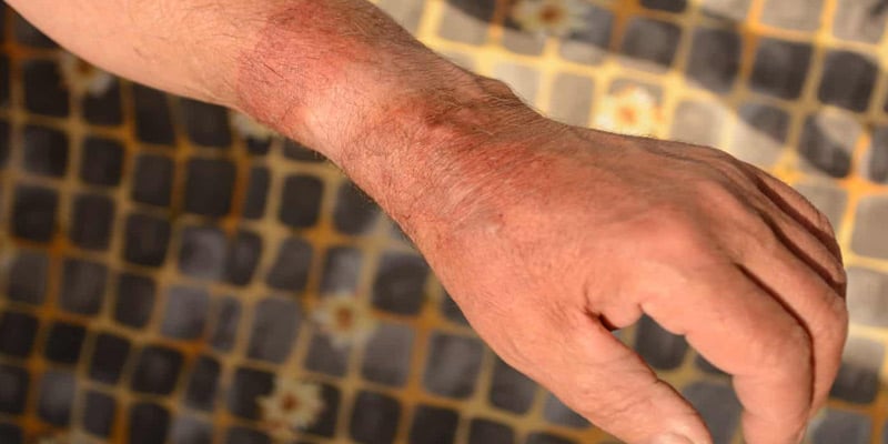 برای پیشگیری از سوختگی پوست با جوشکاری چه باید کرد؟