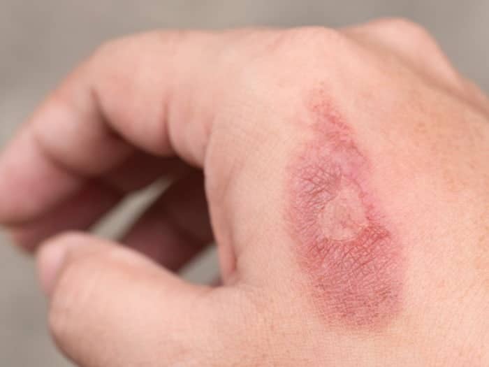 هنگام سوختگی پوست با جوشکاری چه باید کرد؟