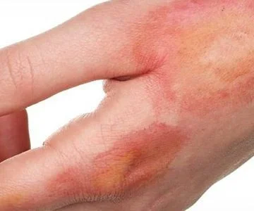 سوختگی پوست با جوشکاری